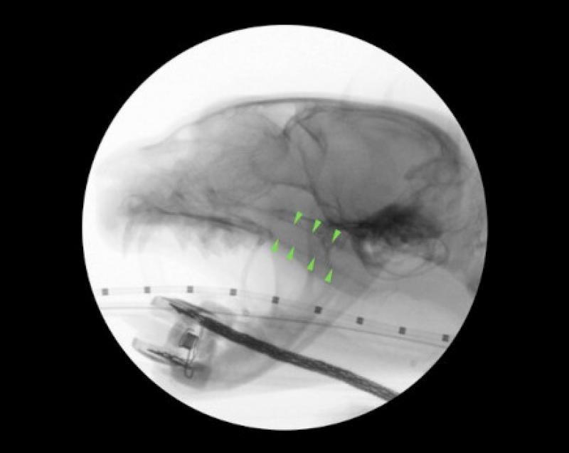 Figura 7A: Aspecto fluoroscópico del stent de silicona implantado a nivel nasofaríngeo (puntas de flecha) (A). Aspecto endoscópico del stent de silicona implantado a nivel nasofaríngeo (B).