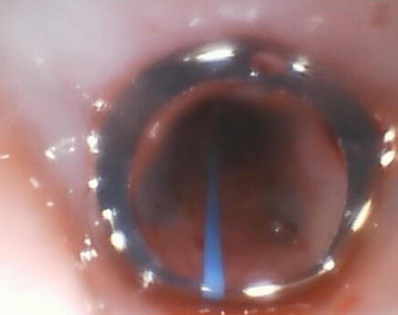 Figura 7B: Aspecto fluoroscópico del stent de silicona implantado a nivel nasofaríngeo (puntas de flecha) (A). Aspecto endoscópico del stent de silicona implantado a nivel nasofaríngeo (B).