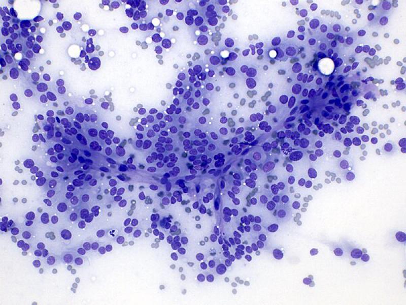 Figura 8 B. Disposición perivascular en tumor adrenocortical (A) y en feocromocitoma (B). Tinción de tipo Romanowsky, objetivo 20x.