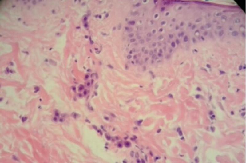 Figura 8: Detalle del corte histopatológico dónde se pueden observar las células mastocíticas en la dermis (mastocitos).
