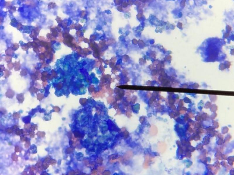 Figura 8. Imagen de la muestra de citología obtenida de bulla timpánica mediante miringotomía. Abundante material azulado de amorfo a granular consistente con moco y un elevado número de eritrocitos. Macrófagos con citoplasma vacuolado y que en muchos casos muestran eritrofagocitosis y abundante hemosiderina en el citoplasma (hemosiderófagos).