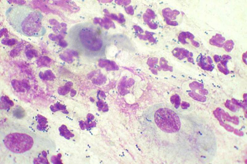 Figura 8. Imágenes de queratoconjuntivitis seca.