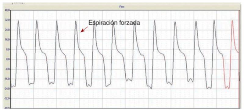 Figura 8. Registro de pletismografía. (B) Registro de un paciente con bronquitis crónica severa. Destaca el pico en la fase respiratoria temprana.