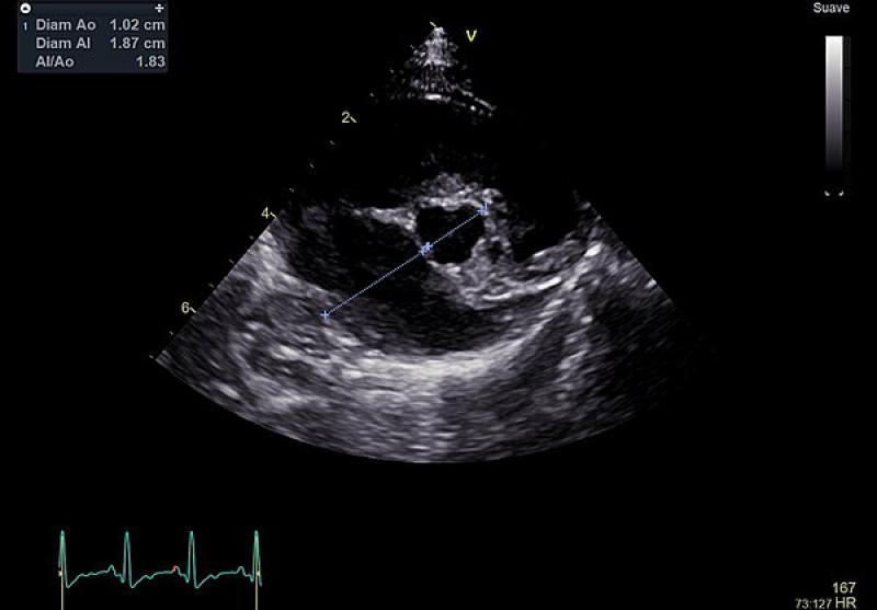 Figura 9. Ecoardiografía: incremento de la relación atrio izquierdo/aorta (1,83) en la vista de eje corto parasternal derecha a nivel de la base cardíaca.