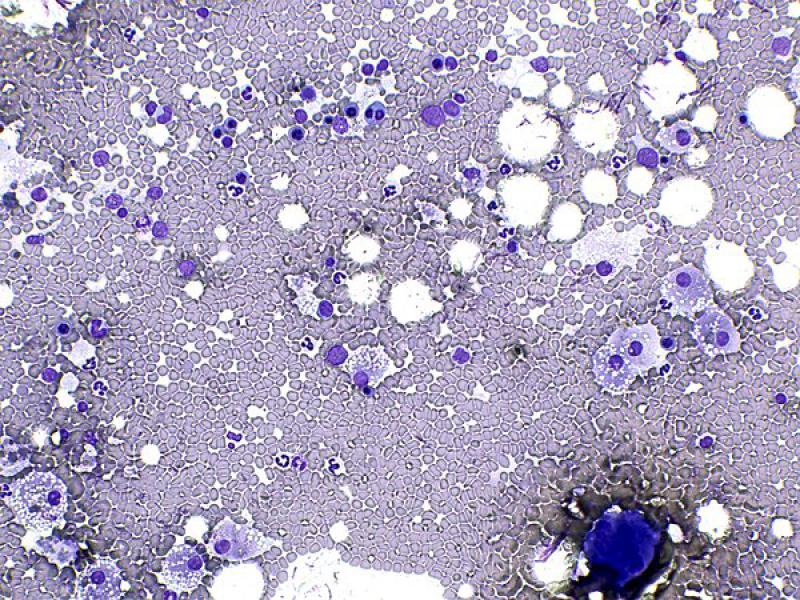 Figura 9. Hematopoyesis extramedular en glándula adrenal. Véanse los precursores hematopoyéticos, con predominio de formas eritroides, en menor proporción precursores mieloides y un megacariocito en esquina inferior derecha (pobre resolución del megacariocito por el contraste de la imagen). Tinción de tipo Romanowsky, objetivo 20x.