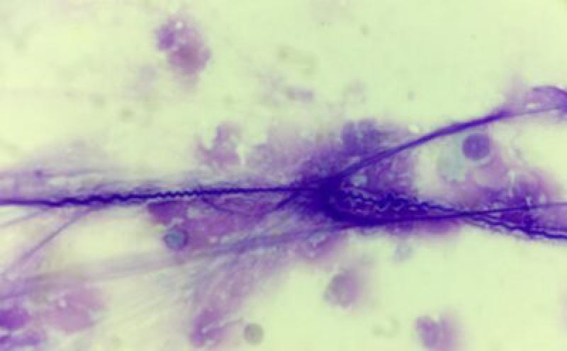 Figura 9. Imagen microscópica (x100). En la imagen de la izquierda se observan una espiral de Curschmann en un lavado broncoalveolar de caballo con enfermedad respiratoria crónica.
