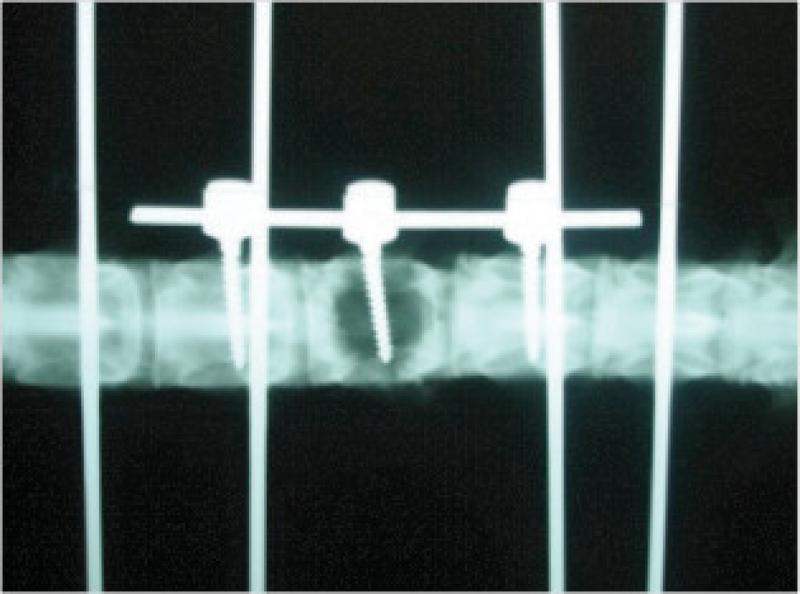 Figura 9. Radiografía post instrumentación.