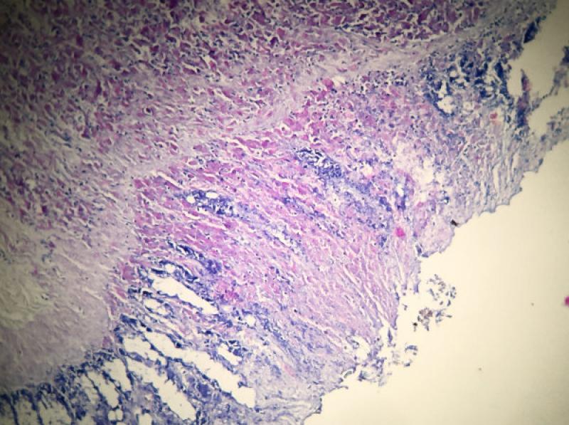 Figura 9. Sector del nódulo descripto en 100X (coloración Ziehl-Neelsen), donde se aprecia la invasión granulomatosa con la superficie de la mucosa intestinal exulcerada que permite que el granuloma y los bacilos sean eliminados al exterior..