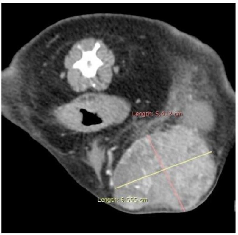Figura 9. Tomografía computerizada de HSA muscular en extremidad posterior