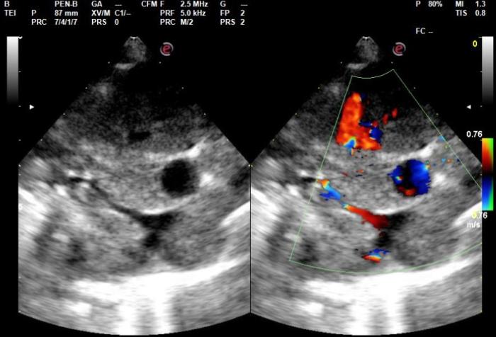Figura 5. En el ecocardiograma Doppler se observó una sobrecarga de volumen en ambas cámaras cardíacas izquierdas, junto a reflujo mitral y tricúspideo moderado a grave (imagen cortesía del Dr. C. Daniel Rodríguez M.N. 9492).