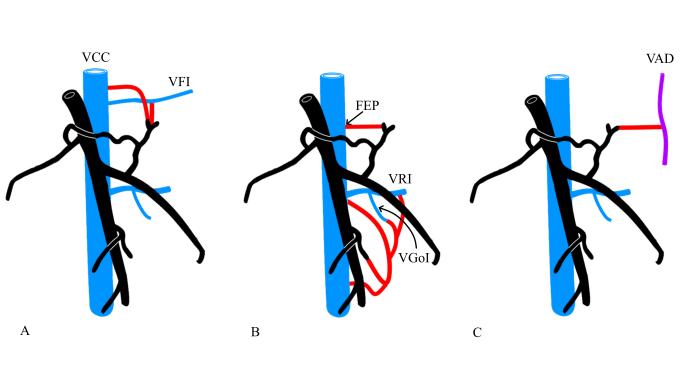 Figura 3. Sitios más frecuentes de inserción de shunt. (A) Porción poshepática de la vena cava caudal. VCC: vena cava caudal. VFI: vena frénica izquierda. (B) Porción prehepática de la vena cava caudal. FEP: foramen epiploico. VRI: vena renal izquierda. VGoI: vena gonadal izquierda. (C) VA: vena ácigos. Adaptado de Robert N. White (ver ref.)15.