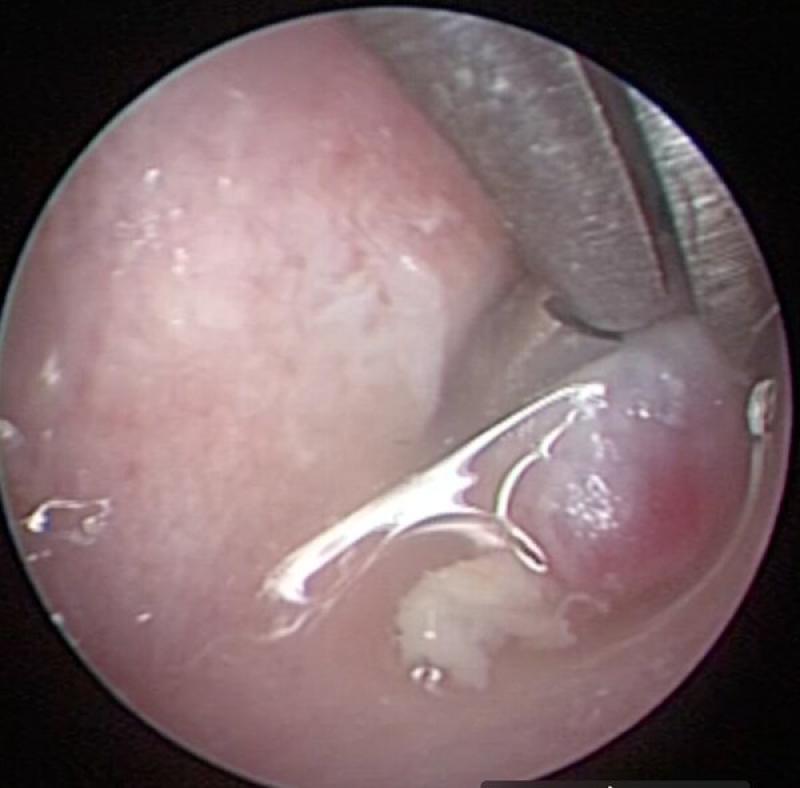 vFigura 9. Extracción de masa en canal auditivo externo mediante pinzas para biopsia