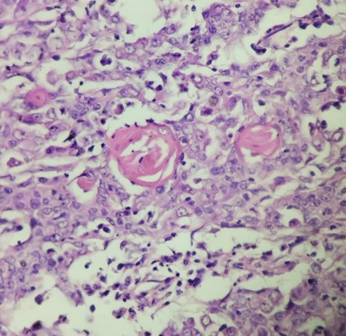 Figura 6. (A) Imagen histológica que corresponde a la lesión tonsilar. (B) Imagen histológica que corresponde a la masa cervical: en ambas se observan islas y trabéculas de células que queratinizan hacia el centro. Las células tienen citoplasma acidófilo y núcleo ovalado con marcada anisocariosis y anisocitosis. (gentileza PAC: Patología Animal Córdoba).